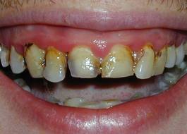 Rutherford dental implants