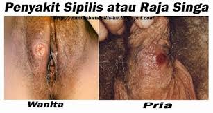 Pada Penyakit Sipilis Atau Raja Singa Pada Penyakit Sipilis Atau Raja Singa