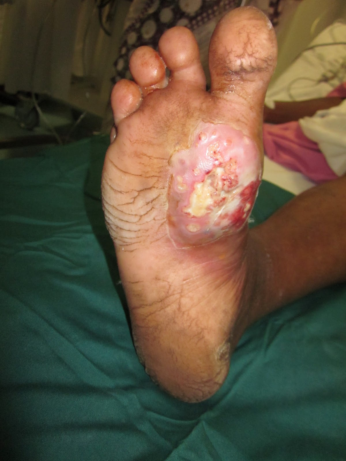 Wet Gangrene Toe