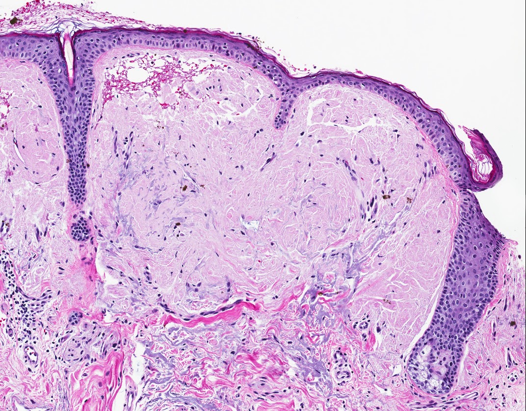 Systemic Amyloidosis Market