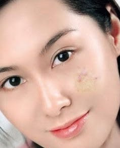 Remove Acne Scars