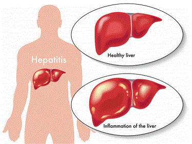 Cada año mueren 1,34 millones de personas por hepatitis - BDM: Blog de Medicina datos sobre la hepatitis
