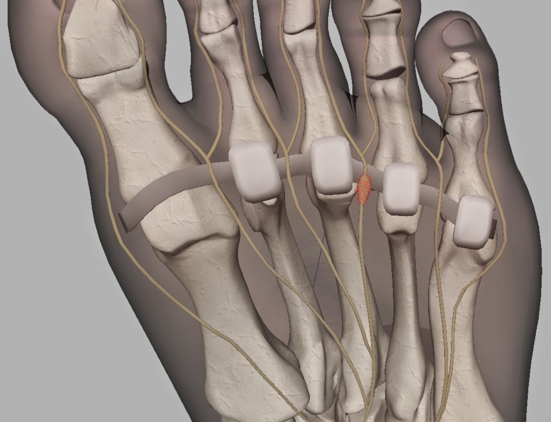 My Running Doc Should a Runner Have Morton's Neuroma Surgery?