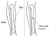 Tibia Diagram Tibia Diagram