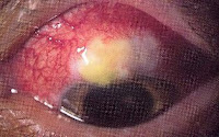 glaucoma, enfermedad de los ojos