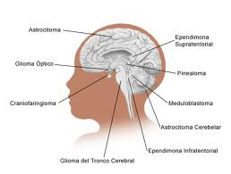 effect of spina bifida on different Most people living with spina bifida will have some loss of bowel control ( neurogenic bowel) there are several factors that affect a successful bowel program. effect of spina bifida on different Most people living with spina bifida will have some loss of bowel control ( neurogenic bowel) there are several factors that affect a successful bowel program.