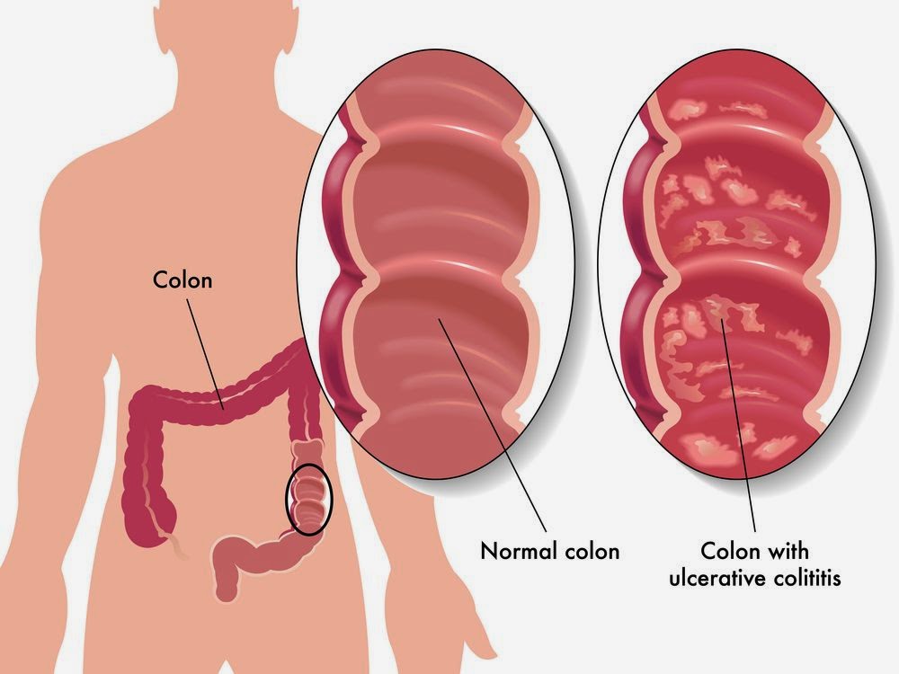 what are the chances of surviving stage 4 liver cancer what are the chances of surviving stage 4 liver cancer