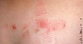 Sacral Herpes - List Of Diseases