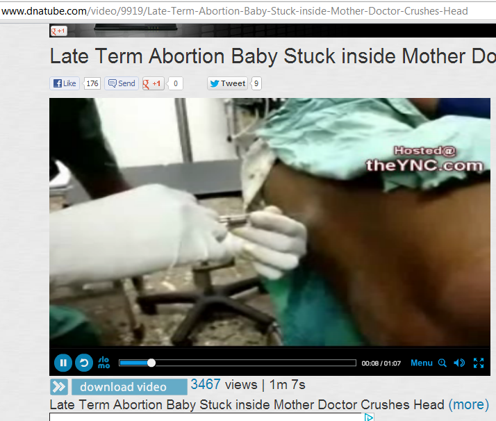 Videos-De-Abortos-Reales Imagenes en video reales aborto por nacimiento parcial legal