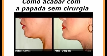 Resultado de imagem para Receita Para Eliminar a Papada sem Cirurgia