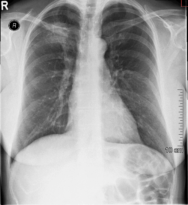 Rheumatologe Chest Xray and nail clubbing