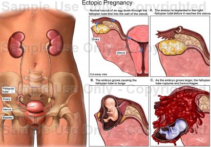 The Danger Ectopic Pregnancy Signs Get Health Pregnant