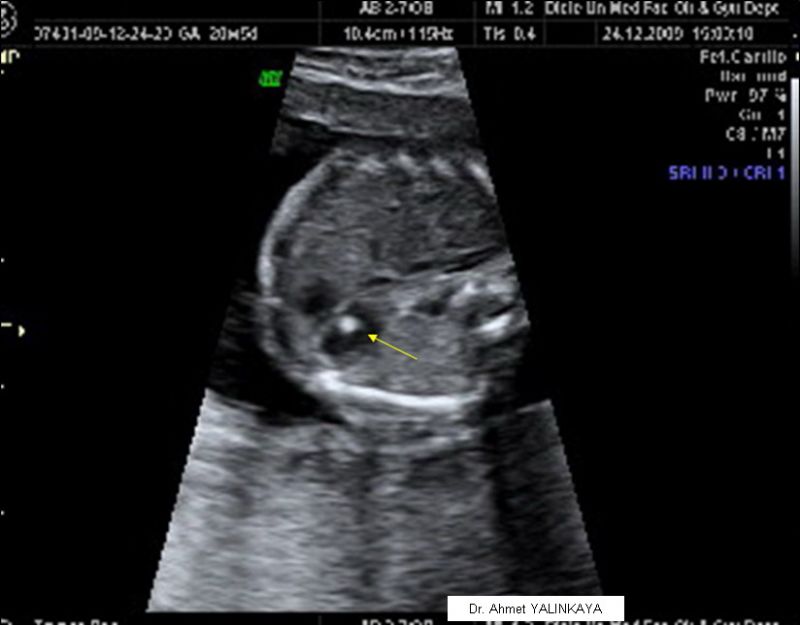 Pediatrist Hiperekojen Odak