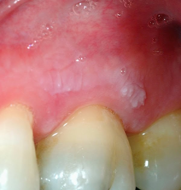 Health Teller: Frictional Keratosis