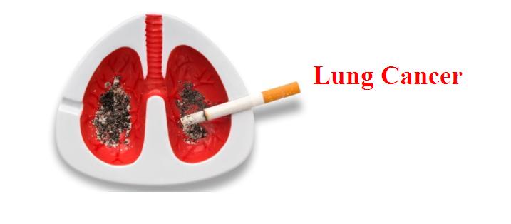 lung cancer