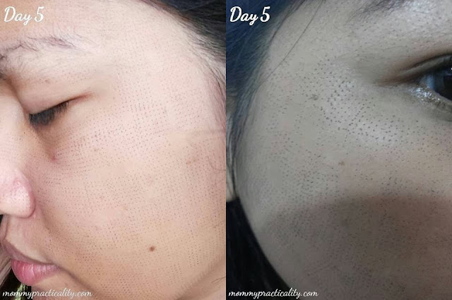 eMatrix Sublative Rejuvenation Treatment