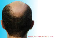 hot oil treatment for hair loss