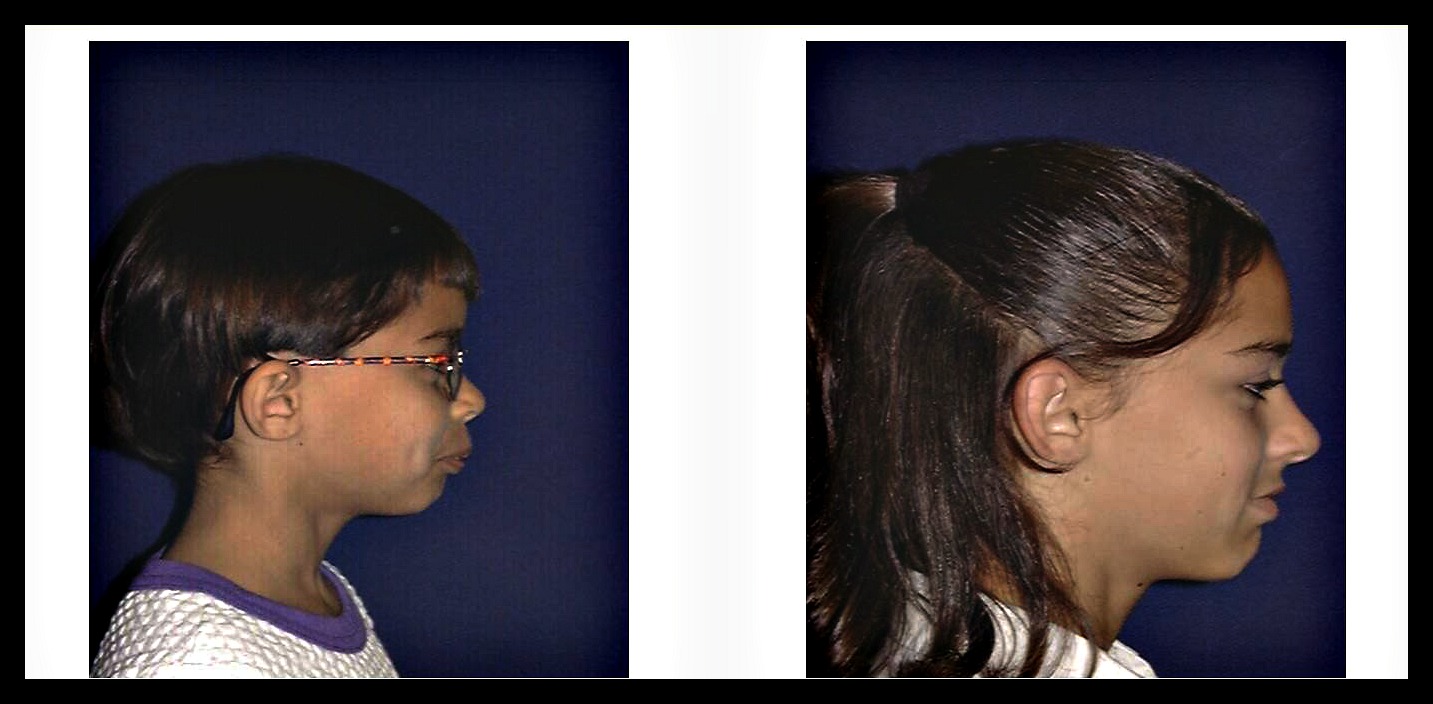 Smile Team Orthodontics What is a Jaw Corrector (Herbst Appliance) and