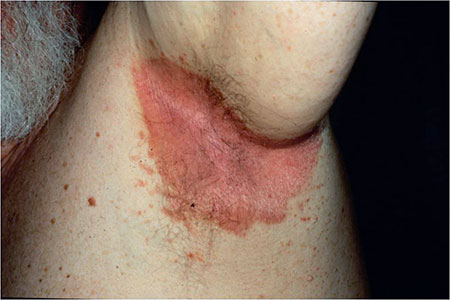 Las manos a la psoriasis inicial