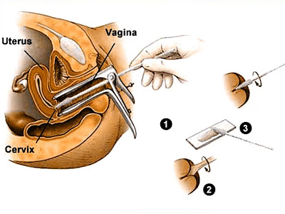 Pemeriksaan Pap Smear