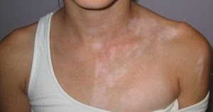 OBAT PENYAKIT KELAINAN PIGMEN | OBAT PENYAKIT KEKURANGAN PIGMEN