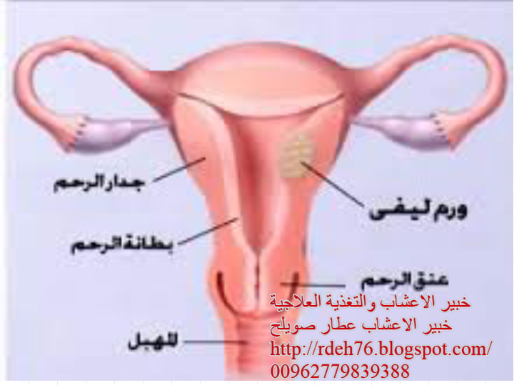 الباحثون السوريون الورم الليفي الرحمي Uterine Fibroid Leiomyoma