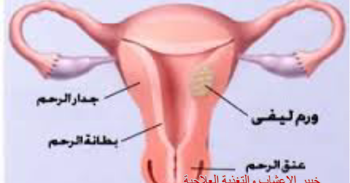 أورام الرحم الليفية السرطان الاورام خبير الاعشاب والتغذية العلاجية عطار صويلح
