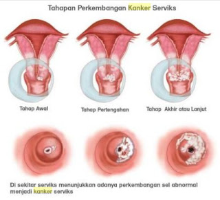 Penjual Obat Kanker Serviks yang sangat Bagus, Pengobatan Ampuh Penyakit Kanker Serviks Rekomendasi Dokter, Pengobatan Herbal Penyakit Kanker Serviks Stadium 4