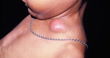 Cara Mengobati Lymphadenitis Kronis