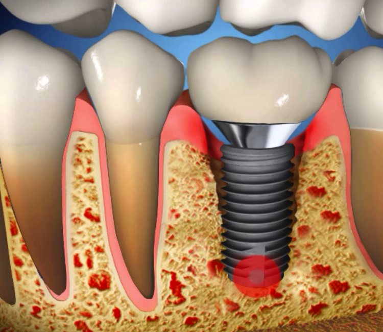 Dental Implant News by Dr. Josh Berd, DDS Clenching and Grinding of