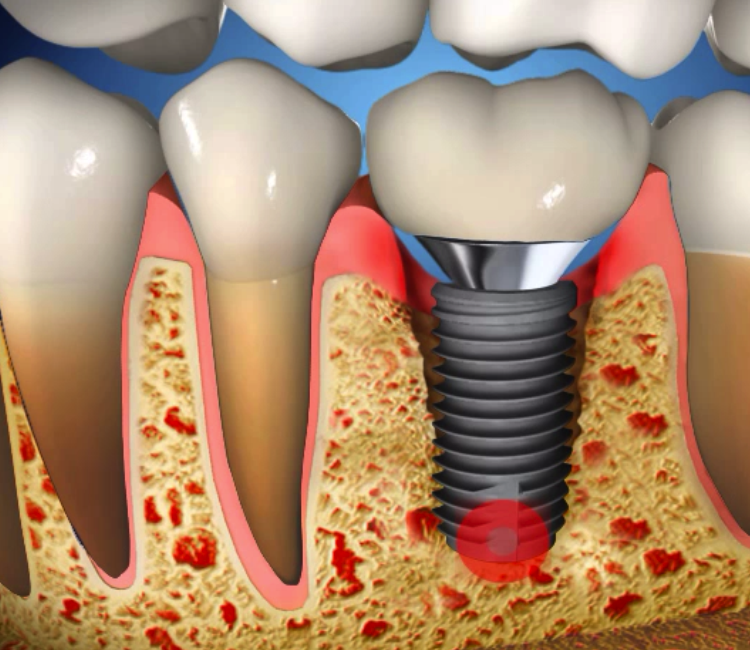 dental implants and teeth grinding