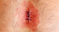 Picture of Cellulitis