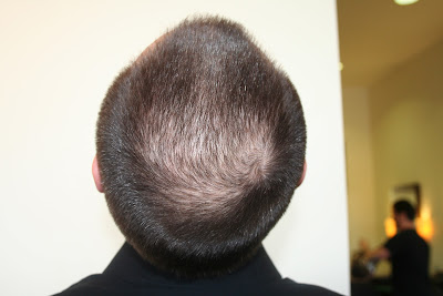 hair does nioxin rogaine stage