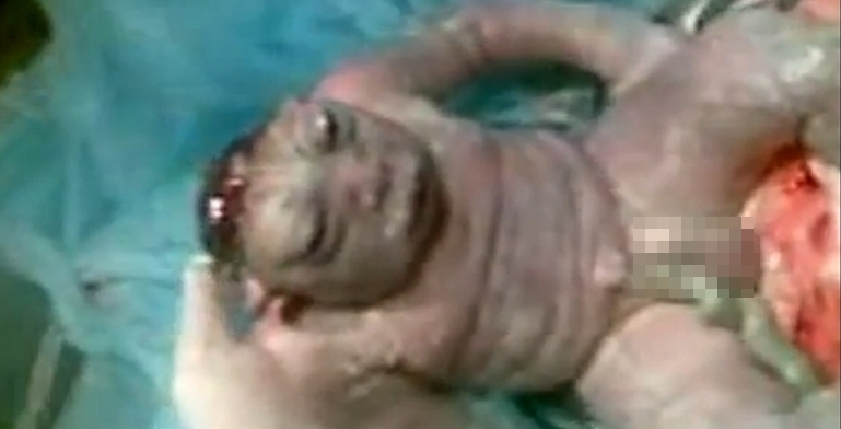 que foi devido a mãe ter pisado em sapo cururu quando na gravidez