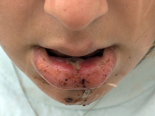 TRATAMIENTOS DENTALES: ¿Tienes Boca seca o Xerostomia? TRATAMIENTOS DENTALES: ¿Tienes Boca seca o Xerostomia?