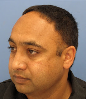 traction alopecia treatment