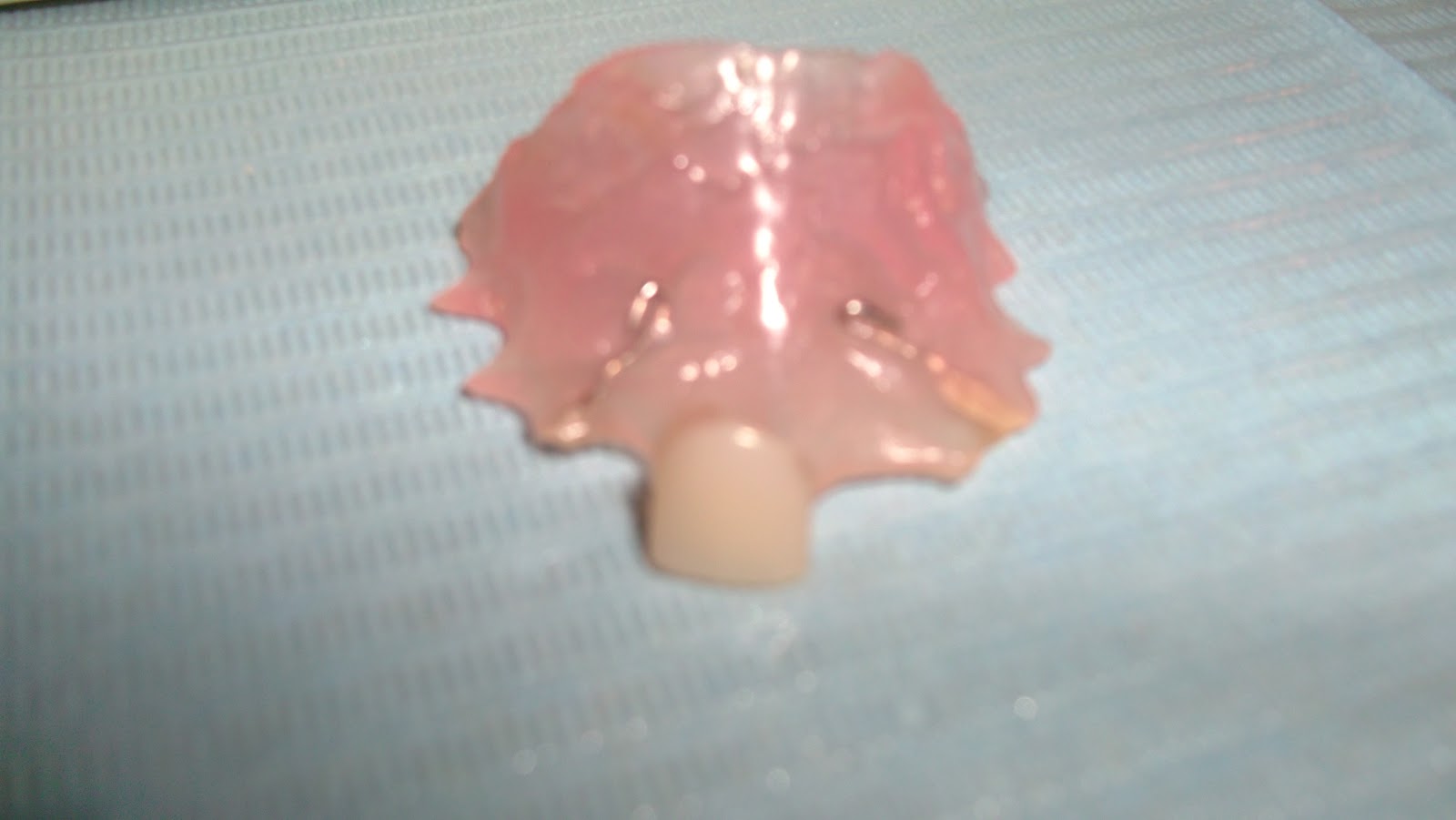 Problems with Removable Partial Denture