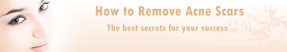 How to Remove Acne Scars 