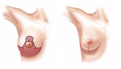 breast uplift surgery cheap breast lift abroad