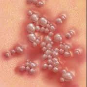 http://herbalalamiteripanglaut.blogspot.com/2015/07/pengobatan-alami-penyakit-kulit.html