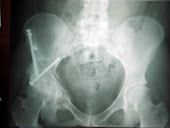 Example hip xray after PAO surgery
