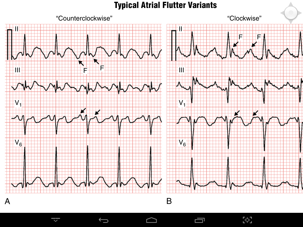 difference between typical and atypical atrial flutter