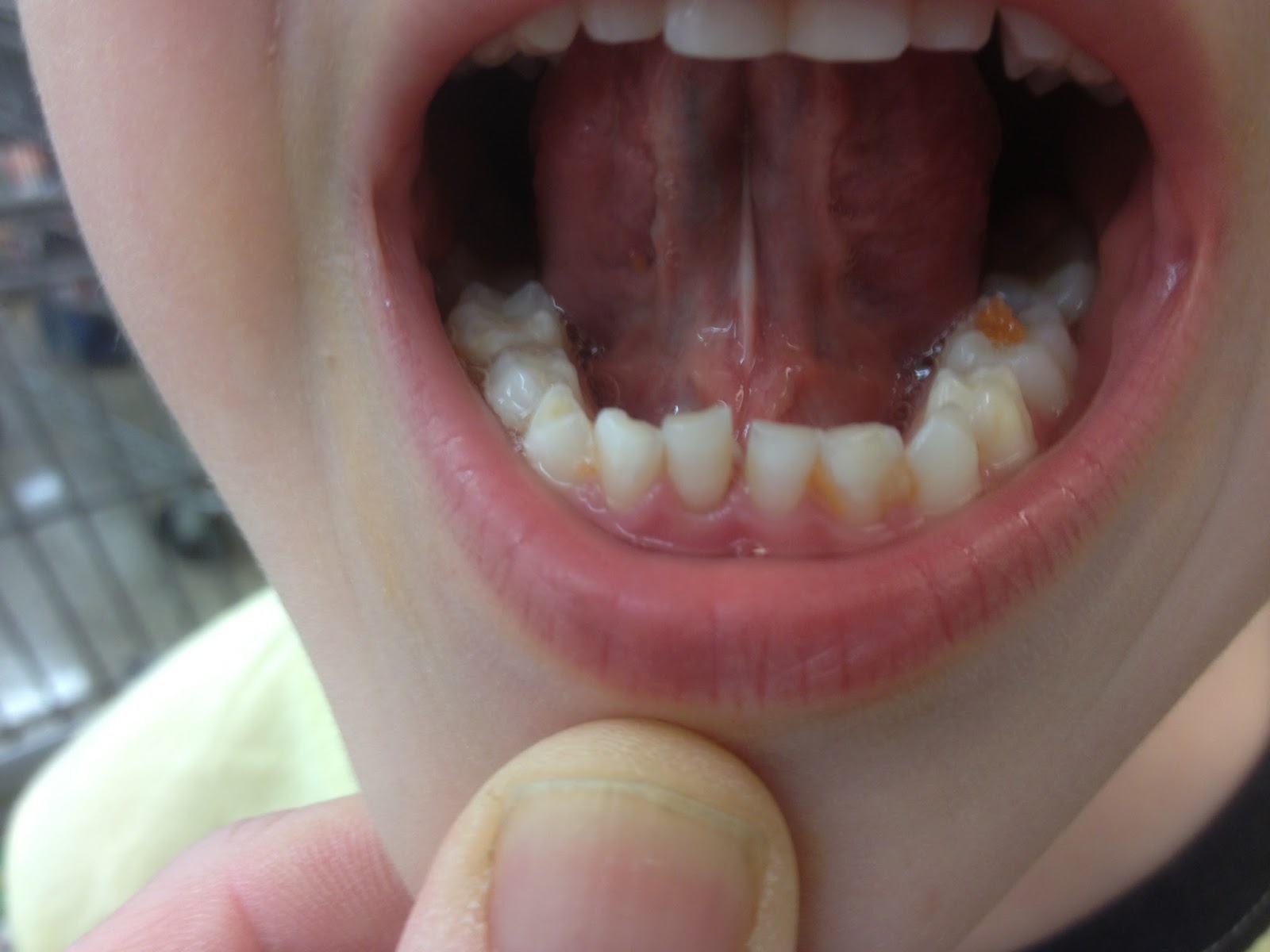 first tooth out