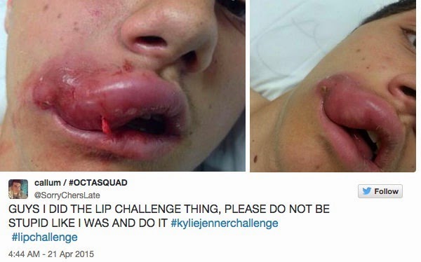 Kylie Jenner Challenge on Instagram Kylie Jenner Challenge: Negative effects