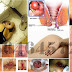 Seputar Penyakit Wasir Dg Obat Herbalnya thumbnail
