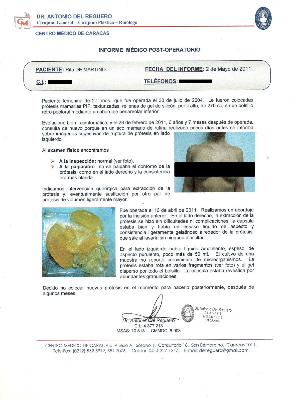 Informe+Pr%25C3%25B3tesis+PIP0001 Conozca la historia de Rita De Martino: Periodista venezolana operada de emergencia por ruptura de implantes PIP