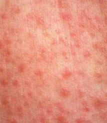 Front door adult in roseola
