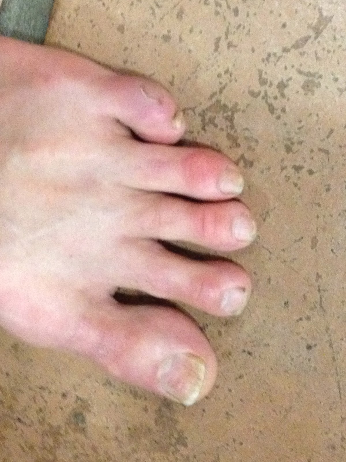 Ultrarunning Fx Blisters &amp; Healing; Skechers GoBionic