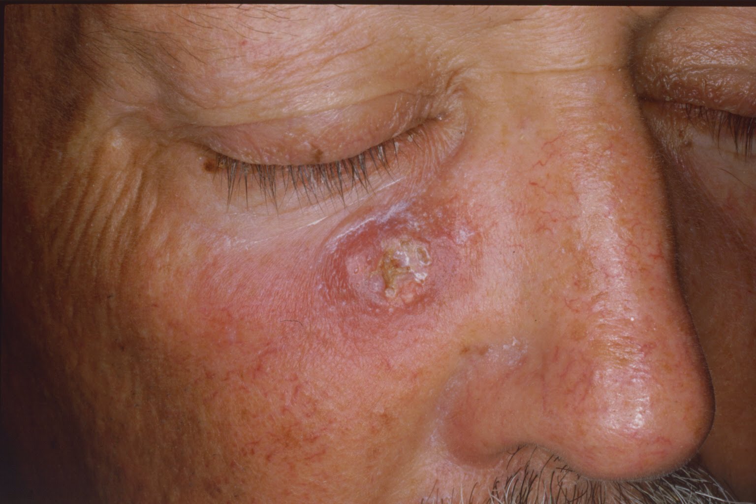 Skin Cancer Identification