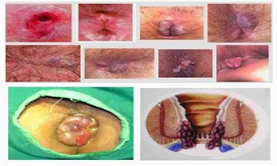 Obat Herbal Untuk Mengatasi Wasir Obat Herbal Untuk Mengatasi Wasir